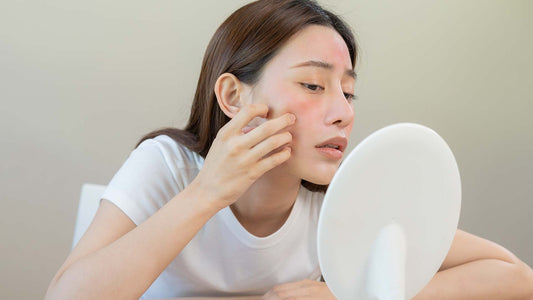 Managing Acne | #DearPauline