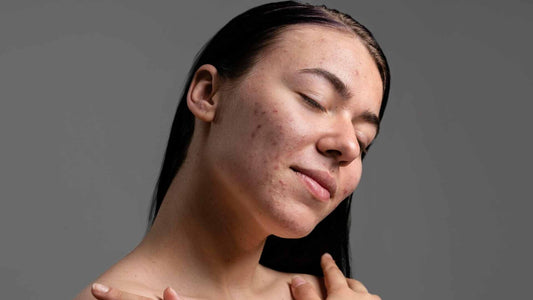 How to Get Acne-Free Skin with Our 5 Pro Tips