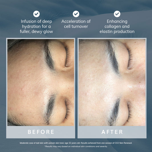 CO2 Skin Renewal