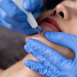Skin Cautery Treatment Skin Cautery Treatment