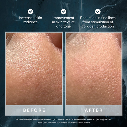 Cryotherapy™ Facial