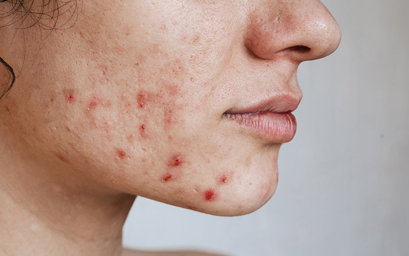 Close-up of the skin of a young girl with acne problem