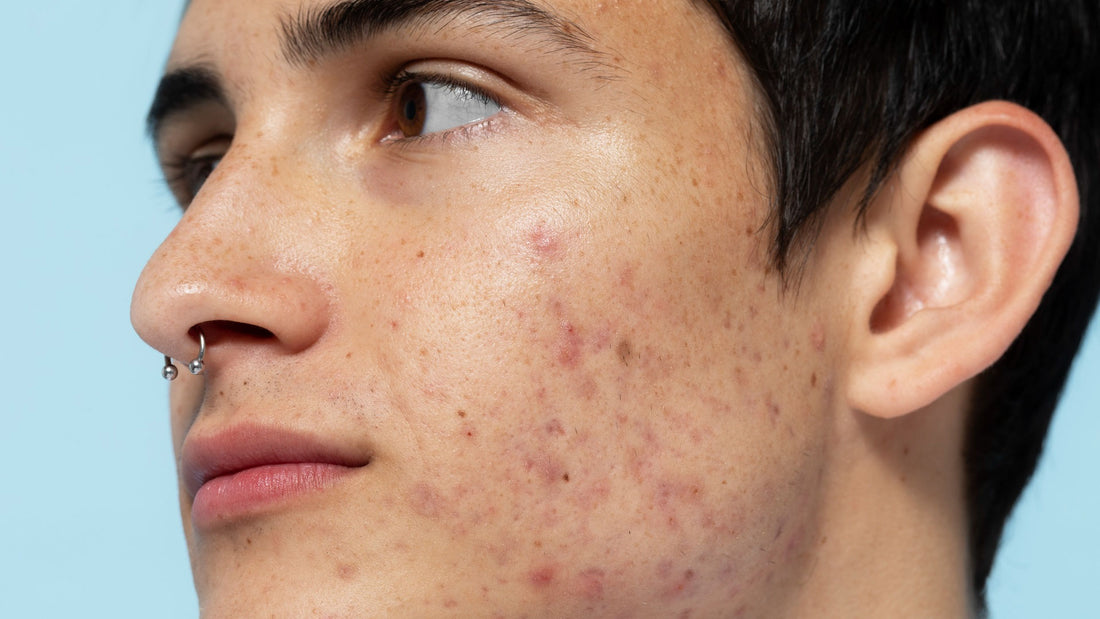 Men’s Oily Skin: 5 Tips to Degrease