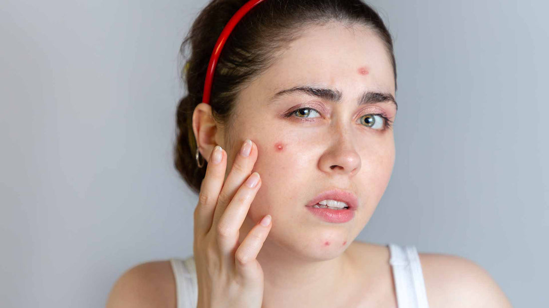 Know Thy Breakout – Your Guide to Treatments for Different Types of Acne