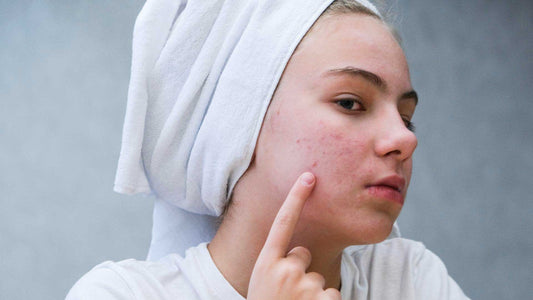 Understanding Acne – Why Some Get It And Some Don’t