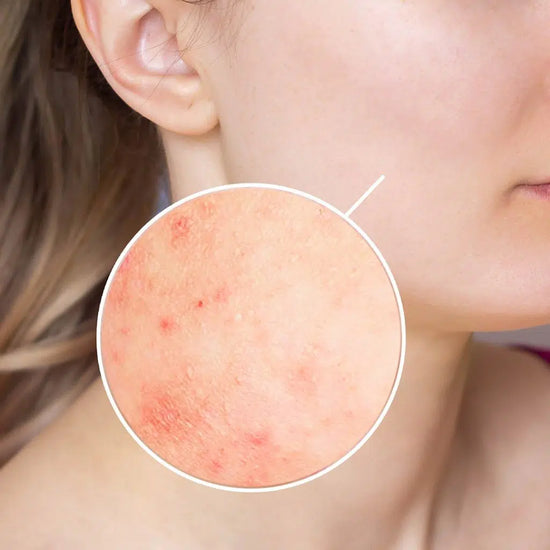 Common Signs of Sensitivity - Skincare for Sensitive Skin