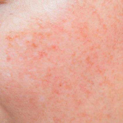 Common Signs of Sensitivity - Skincare for Sensitive Skin